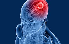 tumour