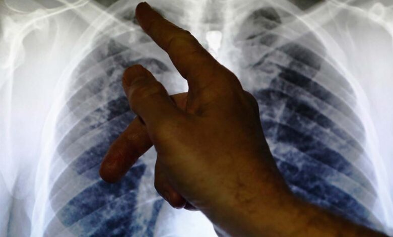 Nigeria registers 300,000 Tuberculosis cases in 2023, Pate announces — Nigeria — The Guardian Nigeria News – Nigeria and World News
