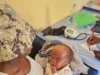 Expert urges early diagnosis, treatment of hydrocephalus